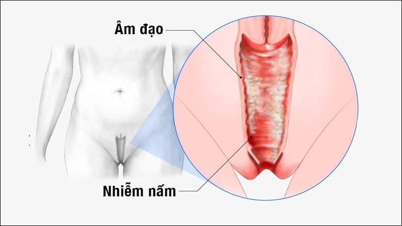 nấm sợi âm đạo