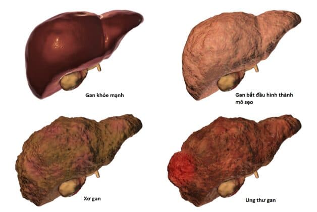 Bệnh ung thư gan hình thành và phát triển như thế nào?