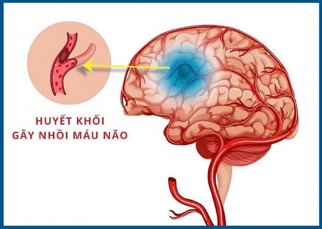 Huyết khối gây đột quỵ nhồi máu não