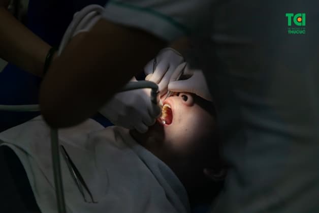 nhiễm trùng sau khi nhổ răng khôn