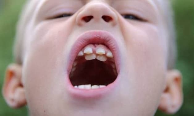 nhổ răng mọc thừa