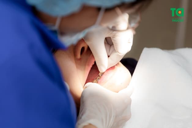 lưu ý về niềng răng mắc cài