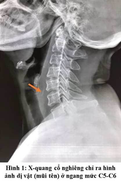 quy trình dị vật họng miệng 3