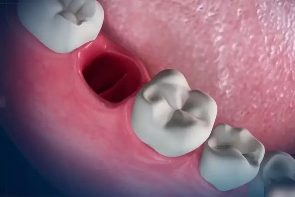 Răng hàm vỡ chỉ còn chân răng có gây nguy hiểm?