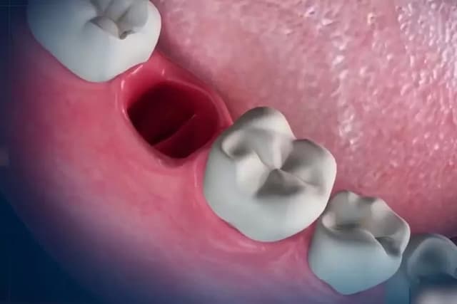 Răng hàm vỡ chỉ còn chân răng có gây nguy hiểm?