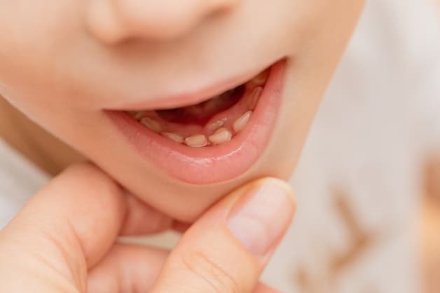 Tình trạng răng mọc lẫy