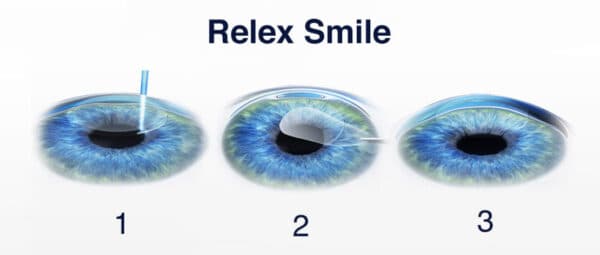 Phương pháp mổ cận RELEX SMILE