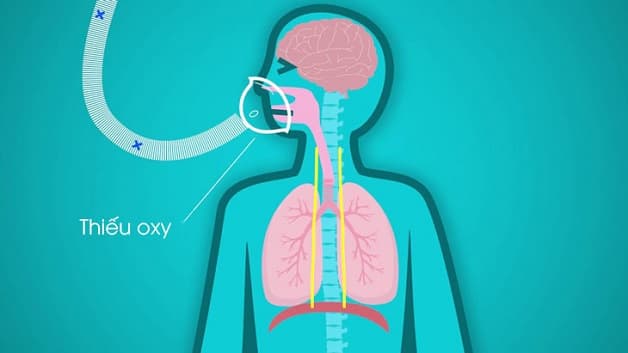 suy hô hấp trong rối loạn thần kinh cơ