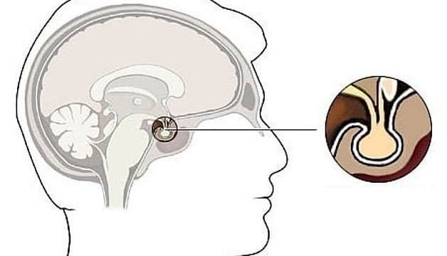 Bệnh suy tuyến yên