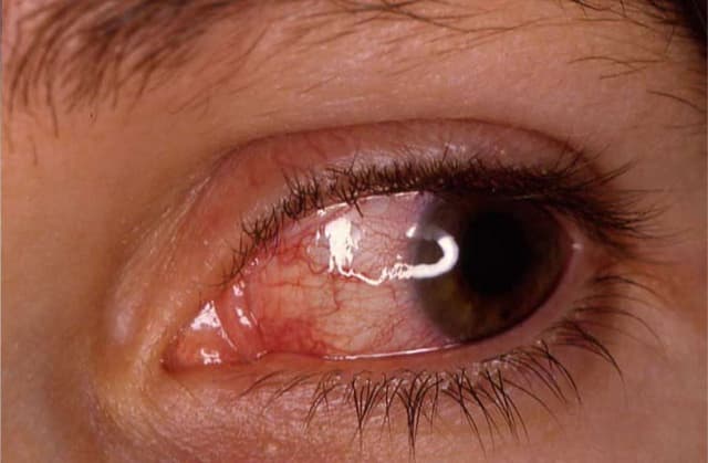 Tắc tĩnh mạch trung tâm võng mạc: dấu hiệu và cách chữa