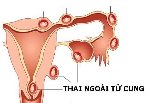 Thai ngoài tử cung sau chuyển phôi là một tình trạng nguy hiểm dù hiếm nhưng vẫn xảy ra 