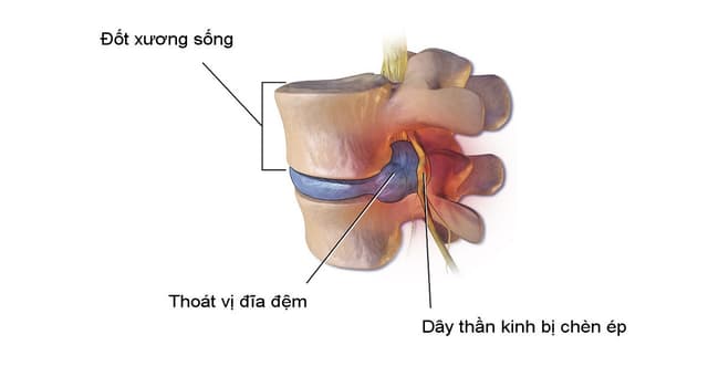 Thoát vị địa đệm: phân loại, triệu chứng và điều trị