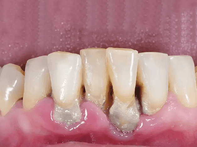 tình trạng tiêu xương răng