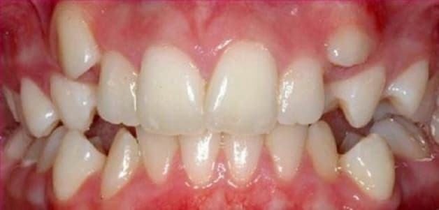 tình trạng răng mọc ngược