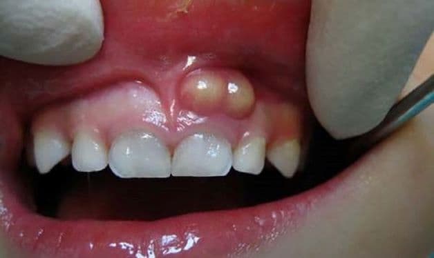 tình trạng viêm chân răng có mủ