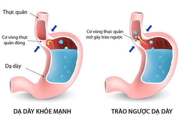nguyên nhân trào ngược dạ dày gây rối loạn nhịp tim
