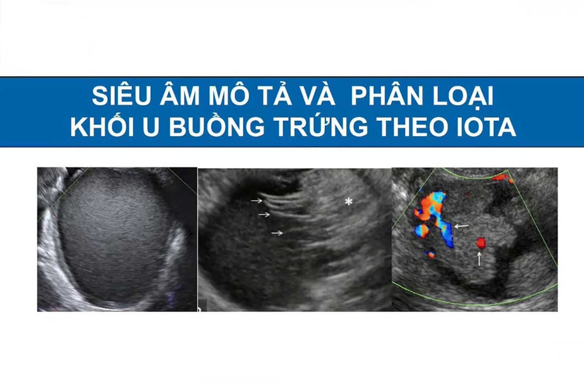 Phân loại u nang buồng trứng theo IOTA được như thế nào?