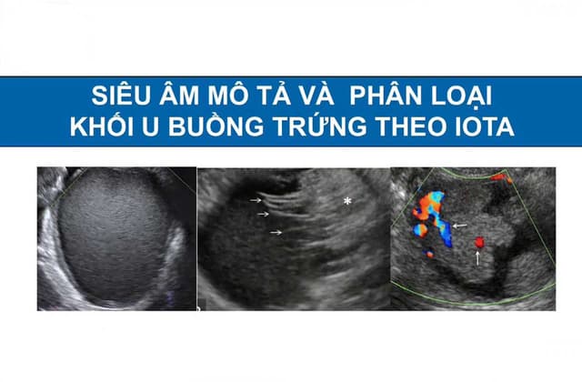 Phân loại u nang buồng trứng theo IOTA được như thế nào?