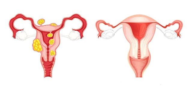 Những cách điều trị u xơ tử cung không cần phẫu thuật