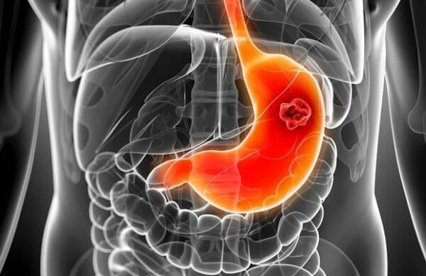 Tìm hiểu chung về ung thư dạ dày giai đoạn 4