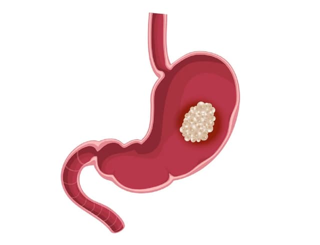 Chữa ung thư dạ dày thế nào hiệu quả?