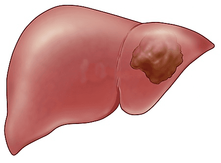 điều cần biết về ung thư gan
