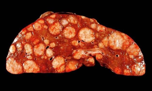 Thông tin quan trọng về ung thư gan giai đoạn di căn ổ bụng