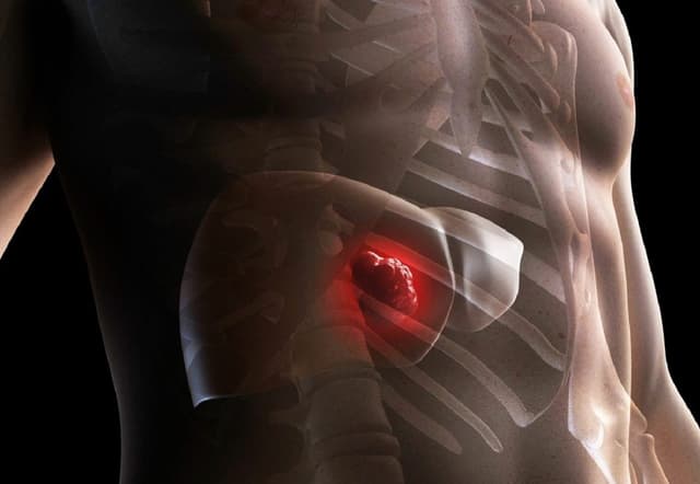 Tìm hiểu về các dấu hiệu ung thư gan giai đoạn cuối