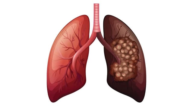 Tổng quan về bệnh ung thư phổi không tế bào nhỏ