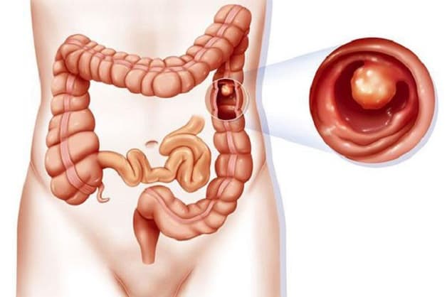Ung thư polyp đại tràng là bệnh lý nguy hiểm ở hệ tiêu hóa