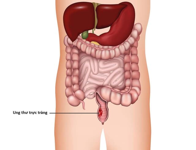 Tất cả thông tin về ung thư trực tràng di căn