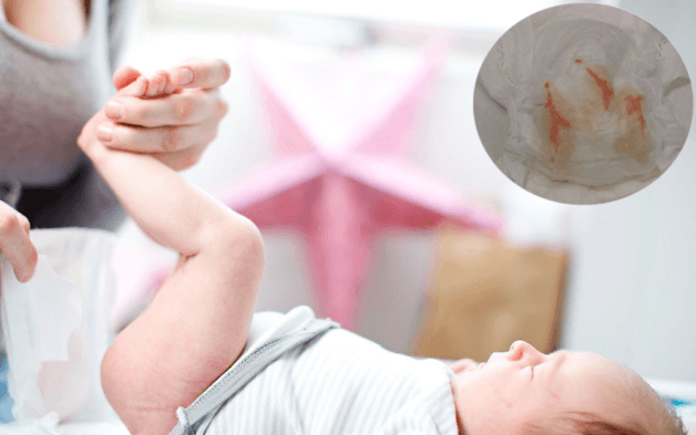 Đi ngoài ra máu là triệu chứng có ý nghĩa quyết định chẩn đoán