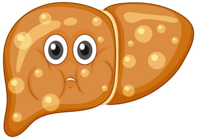 Gan tích tụ quá nhiều chất béo gây ra viêm.