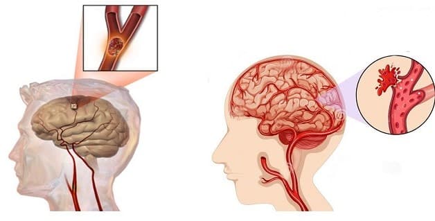Hai dạng tai biến mạch máu não thường gặp