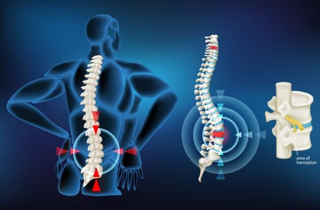 Thoát vị đĩa đệm cột là bệnh gì