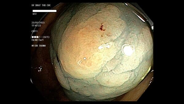 Hình ảnh polyp đại tràng