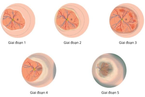 võng mạc trẻ đẻ non
