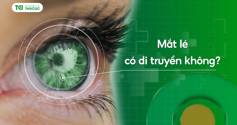 Mắt lé có di truyền không?