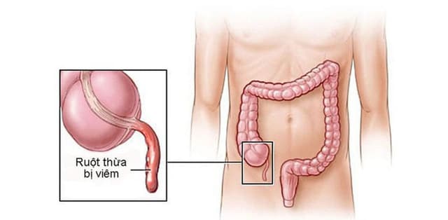 Triệu chứng viêm ruột thừa cấp là gì?