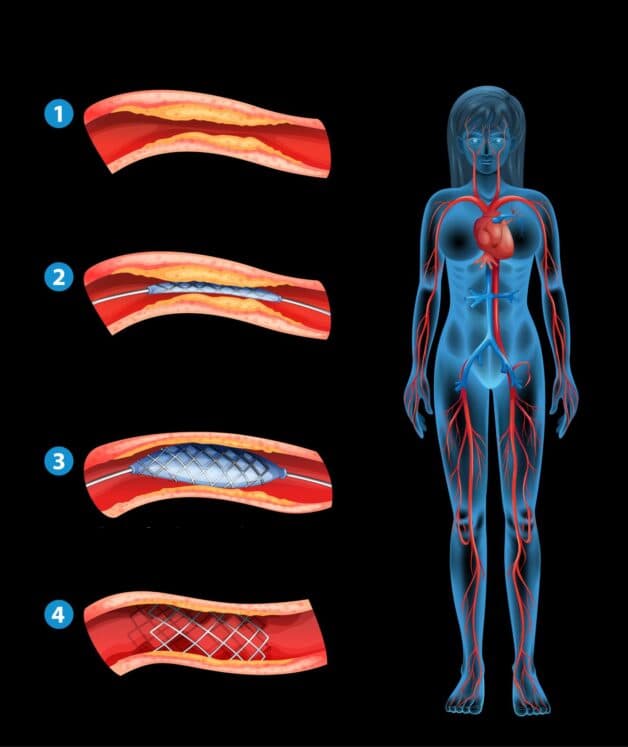 Chữa tai biến mạch máu não nhờ đặt stent