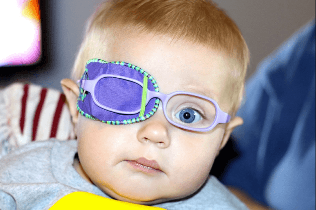 bé bị lác mắt