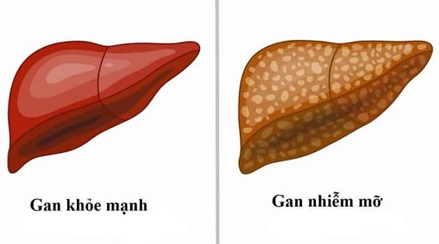 Gan nhiễm mỡ có thể làm tổn thương gan, dẫn đến viêm gan