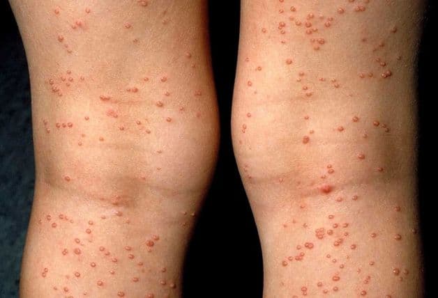 Bệnh lây qua đường tình dục