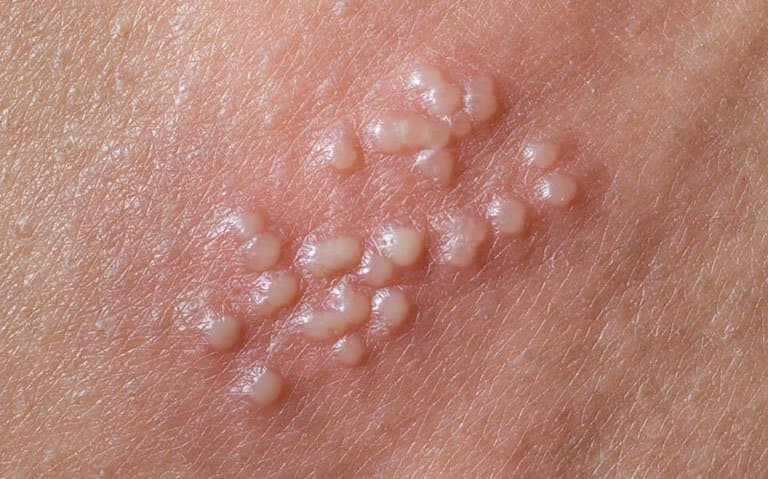 Bệnh herpes sinh dục phát triển nhanh và có thể tái phát nhiều lần trong cuộc đời