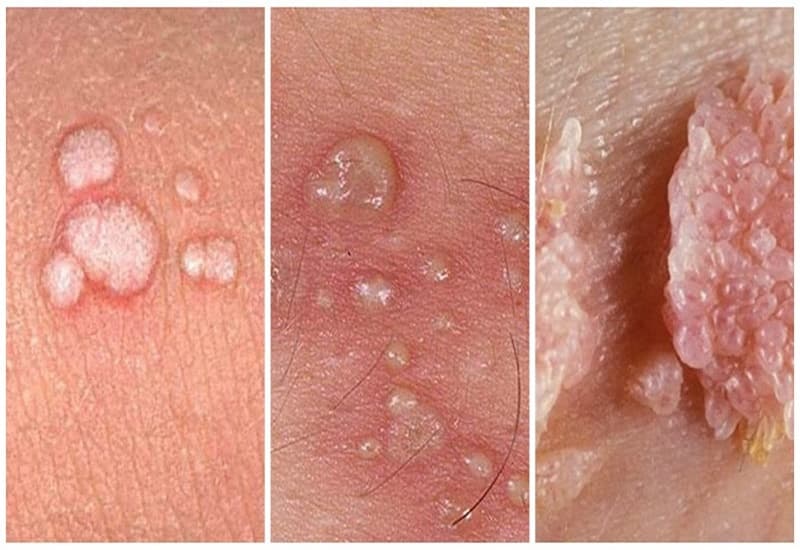 bệnh lây truyền qua đường tình dục