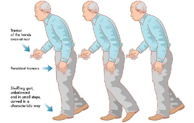 Parkinson là một rối loạn thần kinh tiến triển chậm, thường gặp ở người cao tuổi