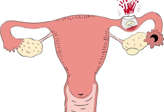 Thai ngoài tử cung có thể gây xuất huyết