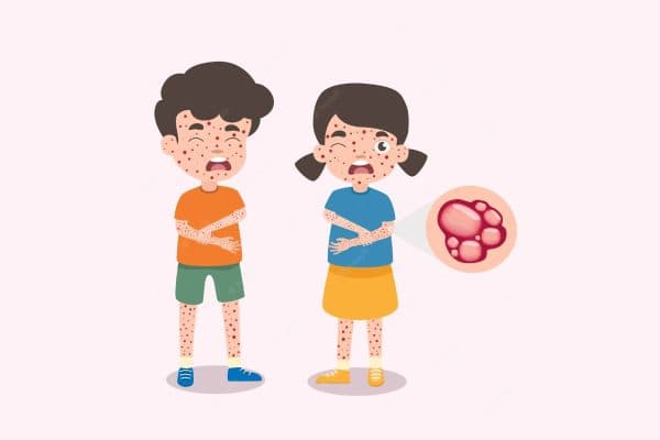 Thủy đậu là bệnh lý thường gặp ở trẻ nhỏ, có khả năng lây lan và bùng phát thành dịch