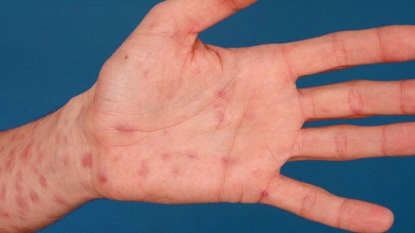 Giang mai là bệnh tình dục phổ biến và triệu chứng điển hình là xuất hiện vết loét không đau