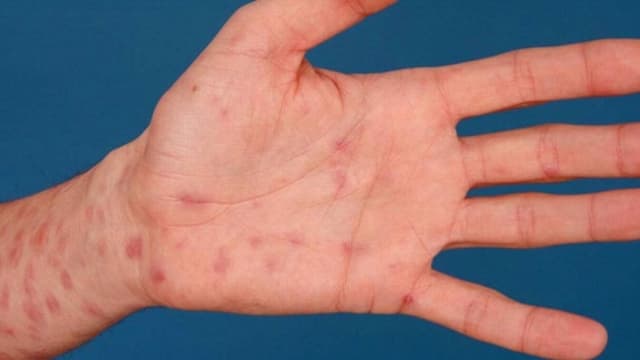 Tổng hợp bệnh tình dục phổ biến và triệu chứng thường gặp